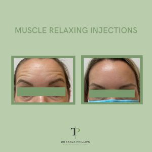 Before-and-after comparison of forehead lines following muscle relaxing injections in clinic.