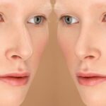 Dermal Fillers