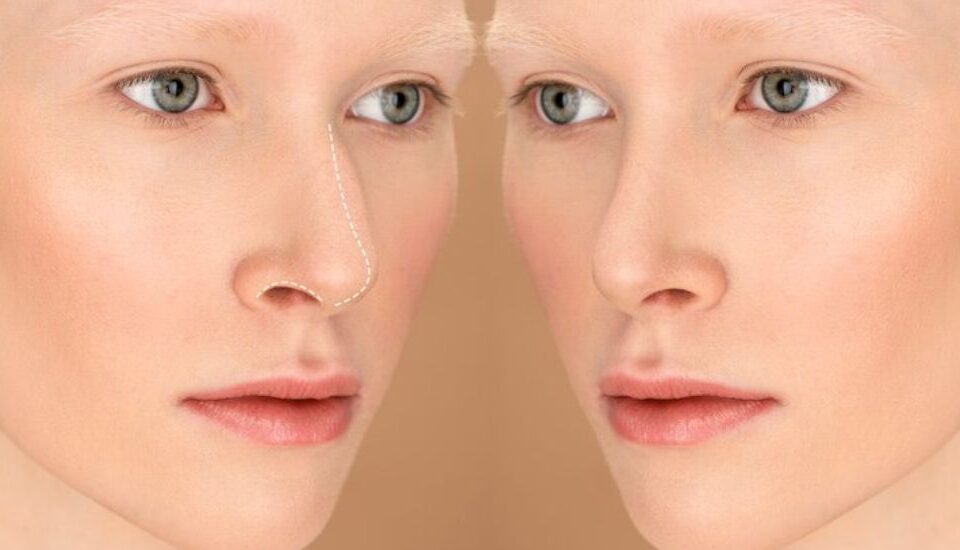 Dermal Fillers