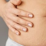 Eliminate Stretch Marks