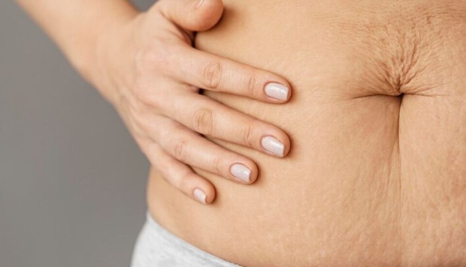 Eliminate Stretch Marks