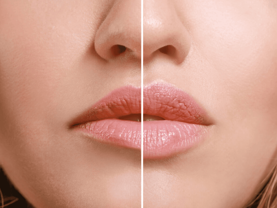 LIP INJECTION