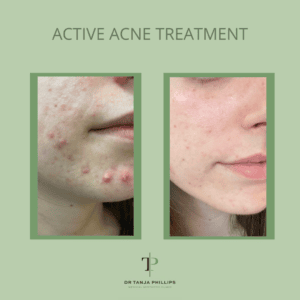Acne Treatment
