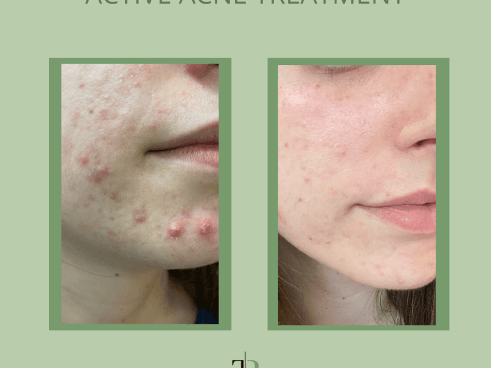 Acne Treatment
