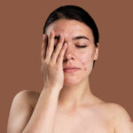 Laser Treatments Help Acne Scars?
