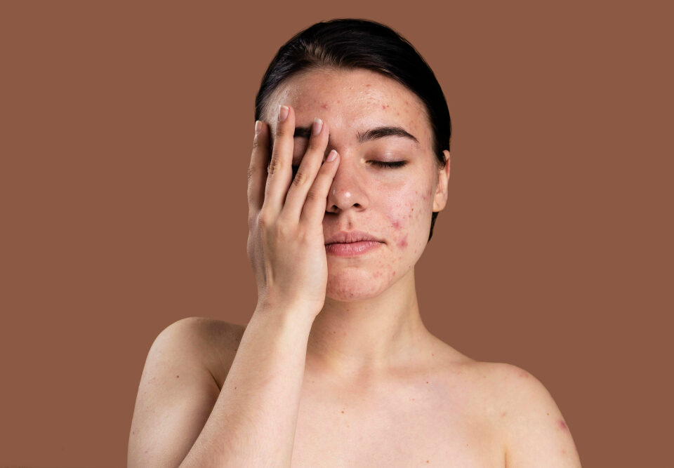 Laser Treatments Help Acne Scars?