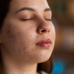 Laser Acne Treatment