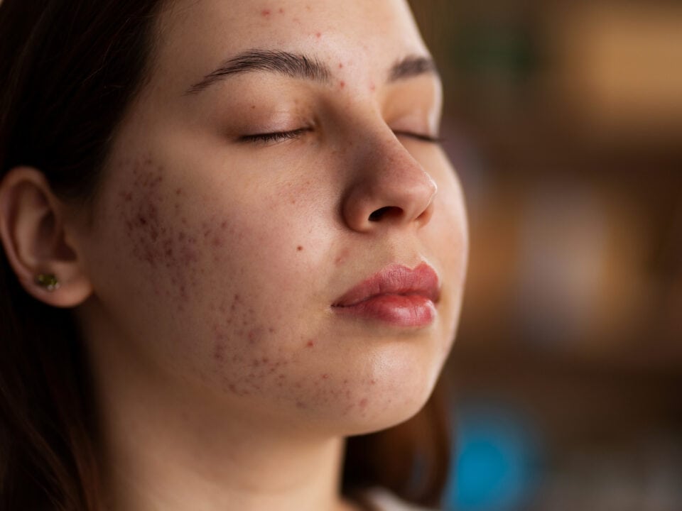 Laser Acne Treatment