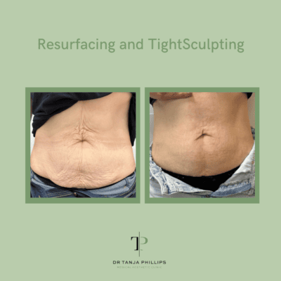 Resurfacing and TightSculpting of the stomach (1)