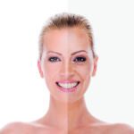 non-surgical facelift