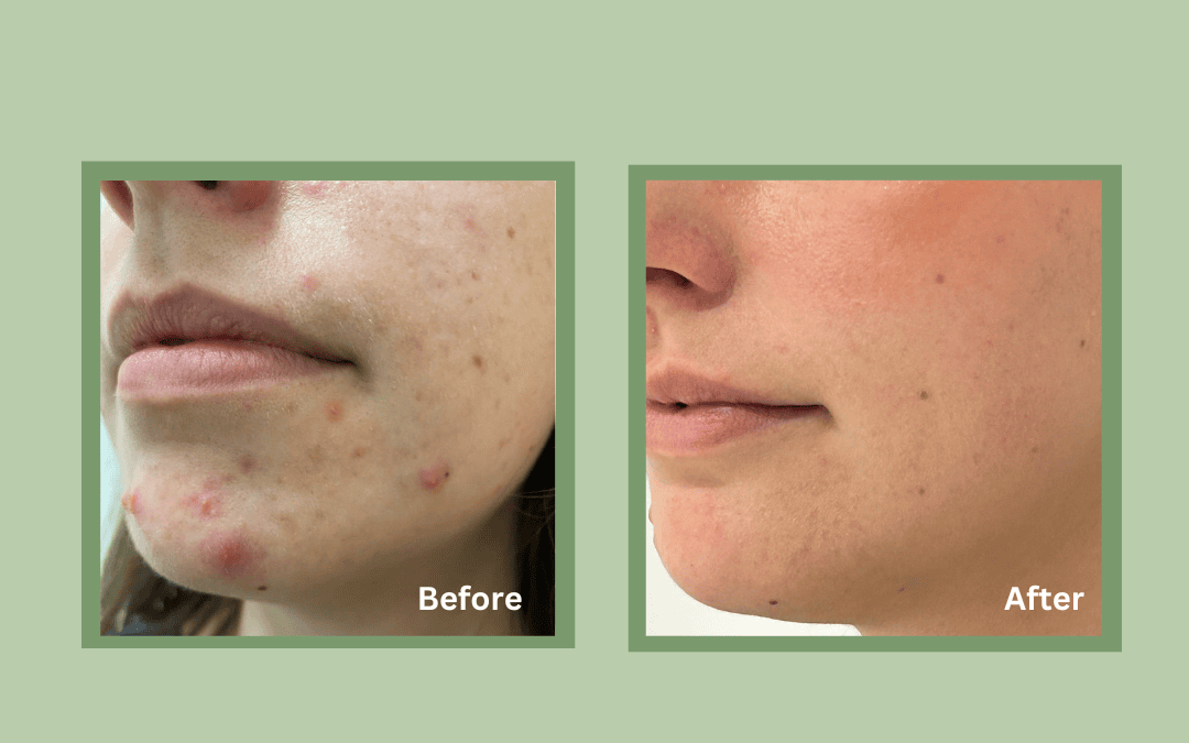 Laser Acne Scar Removal