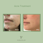 Laser Acne Scar Removal