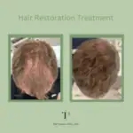 Hair Restoration Treatment