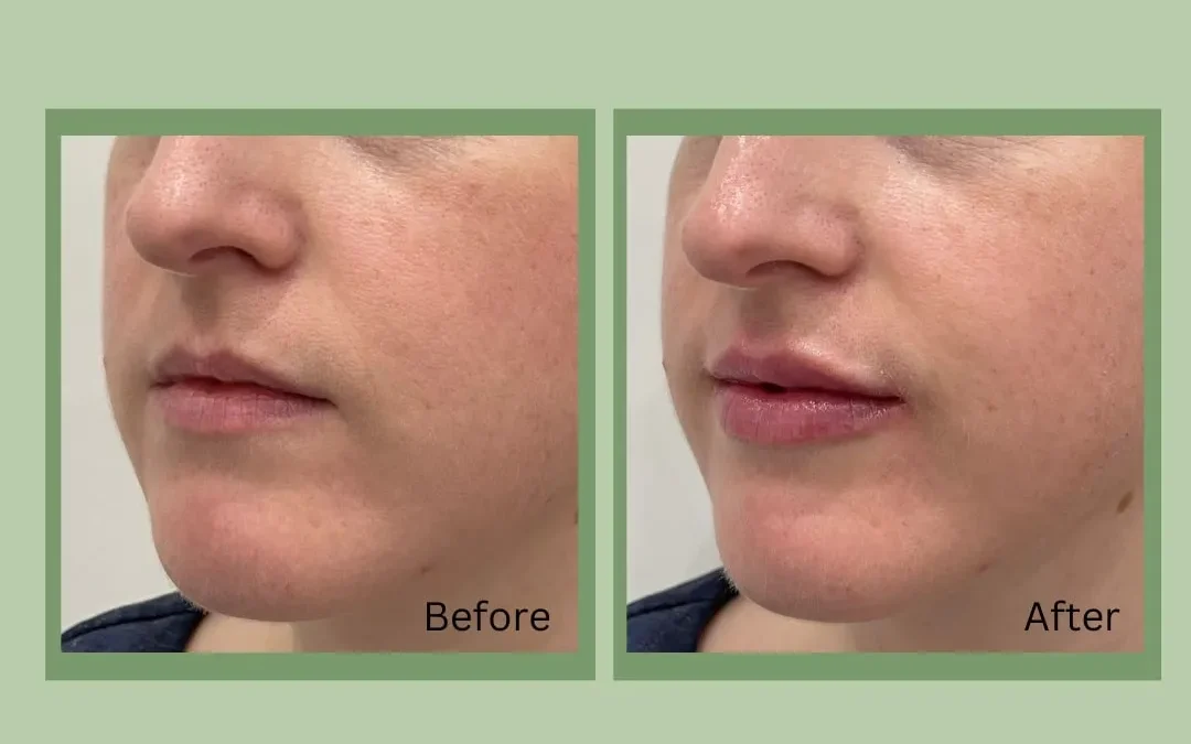 lip fillers