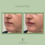 lip fillers