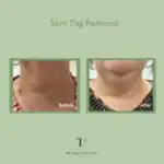 Remove Skin Tags