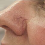 Thread Vein Treatment