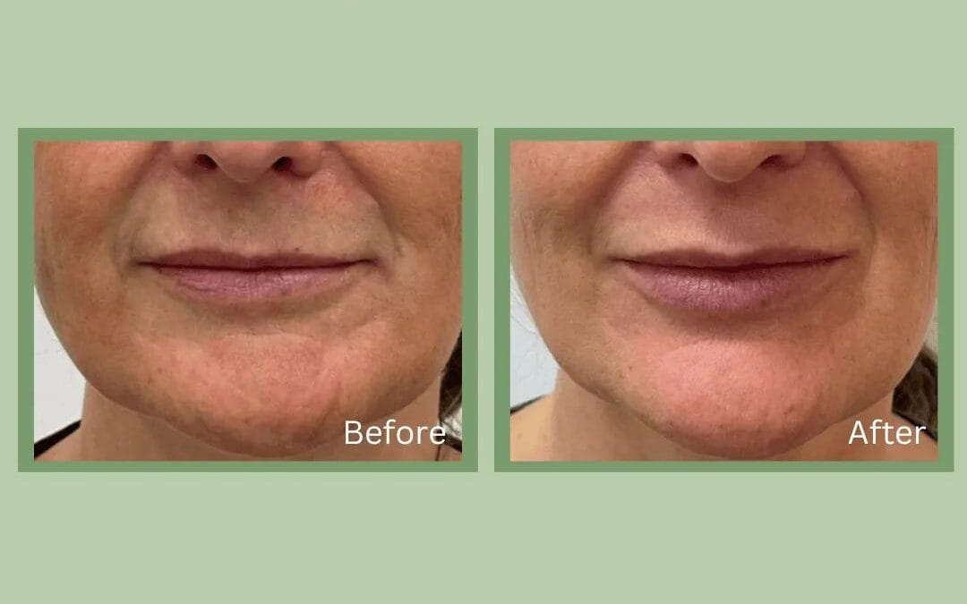 Dermal Fillers