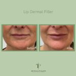 Dermal Fillers
