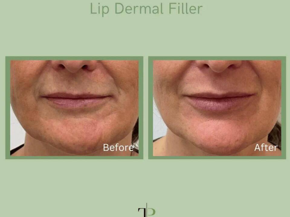 Dermal Fillers