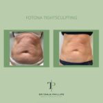 Body Sculpting