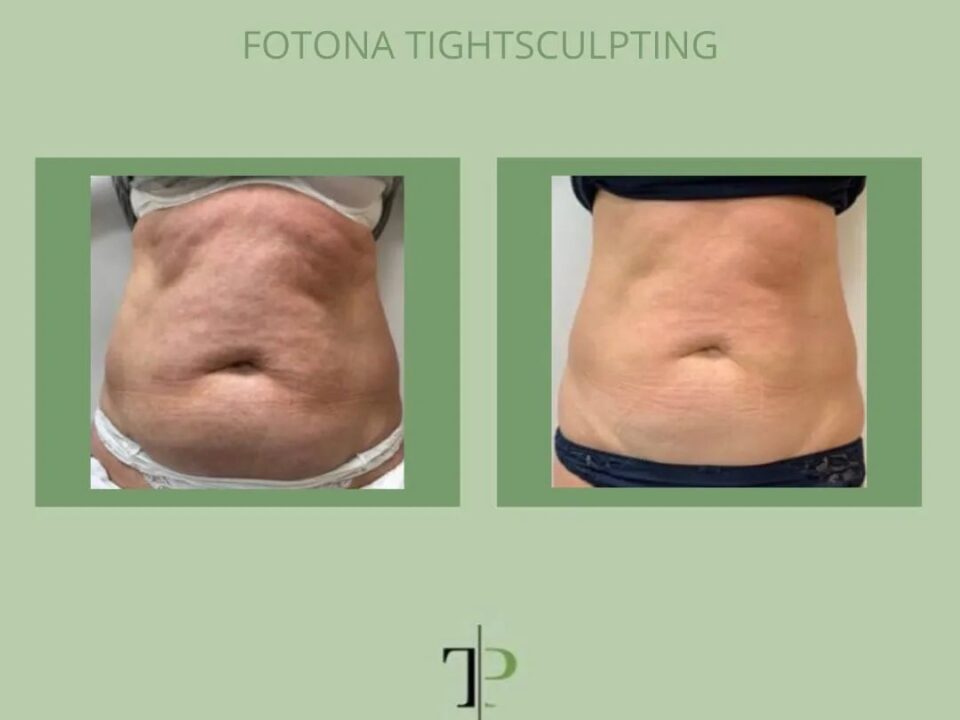 Body Sculpting