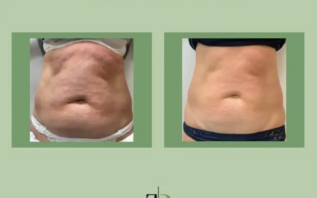 Laser Lipolysis