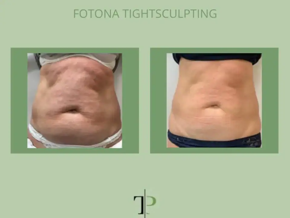 Laser Lipolysis