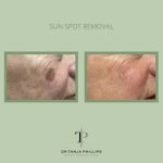 Remove Age Spots on Face